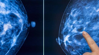 Mammografie für Früherkennung – Schweizweit grosse Unterschiede bei der Brustkrebs-Vorsorge